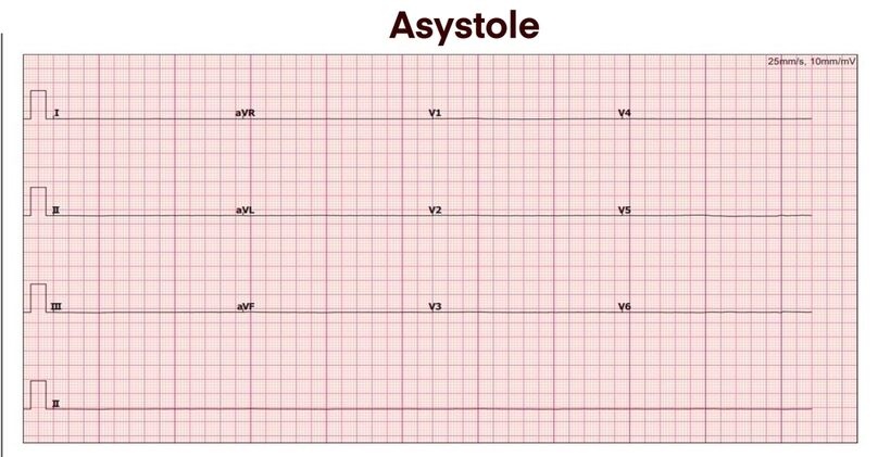 asystole meaning causes ecg signs and acls response guide