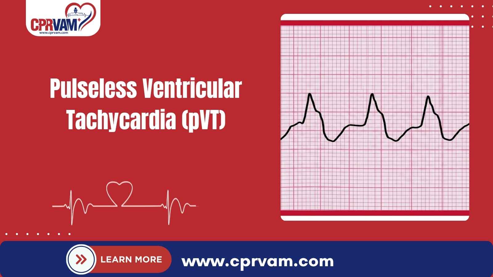 pulseless ventricular tachycardia (pVT) cardiac rhythm explained