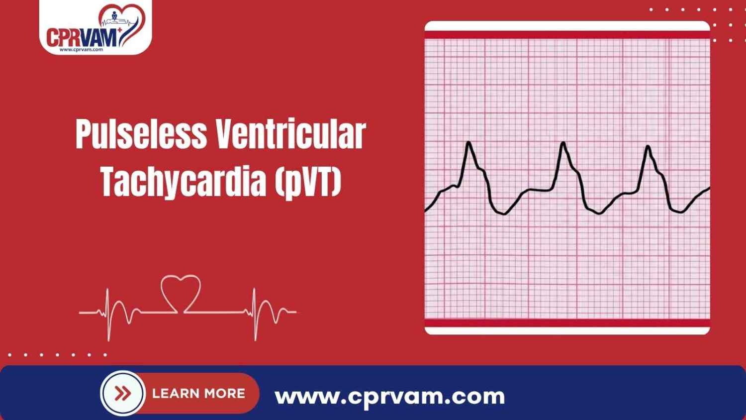 Pulseless vtach rhythm on an ecg monitor during cardiac arrest
